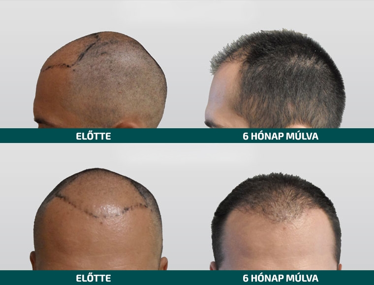 Doctor Hair Clinic Hajbeültetés referencia #1