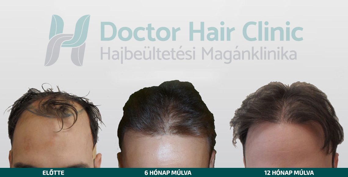 Doctor Hair Clinic Hajbeültetés referencia #2