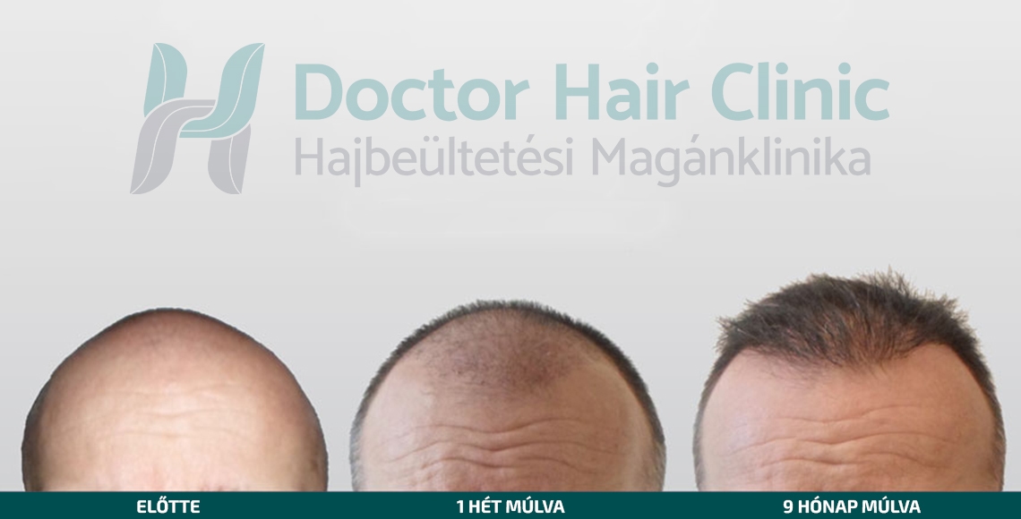 Doctor Hair Clinic Hajbeültetés referencia #3