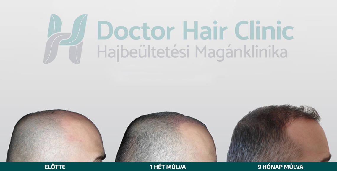 Doctor Hair Clinic Hajbeültetés referencia #4