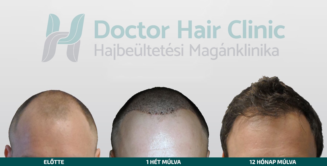 Doctor Hair Clinic Hajbeültetés referencia #5