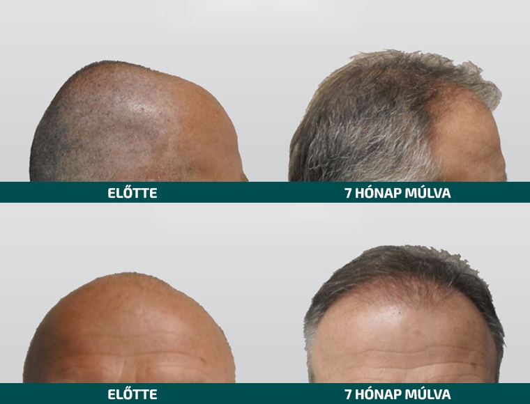 Doctor Hair Clinic Hajbeültetés referencia #6