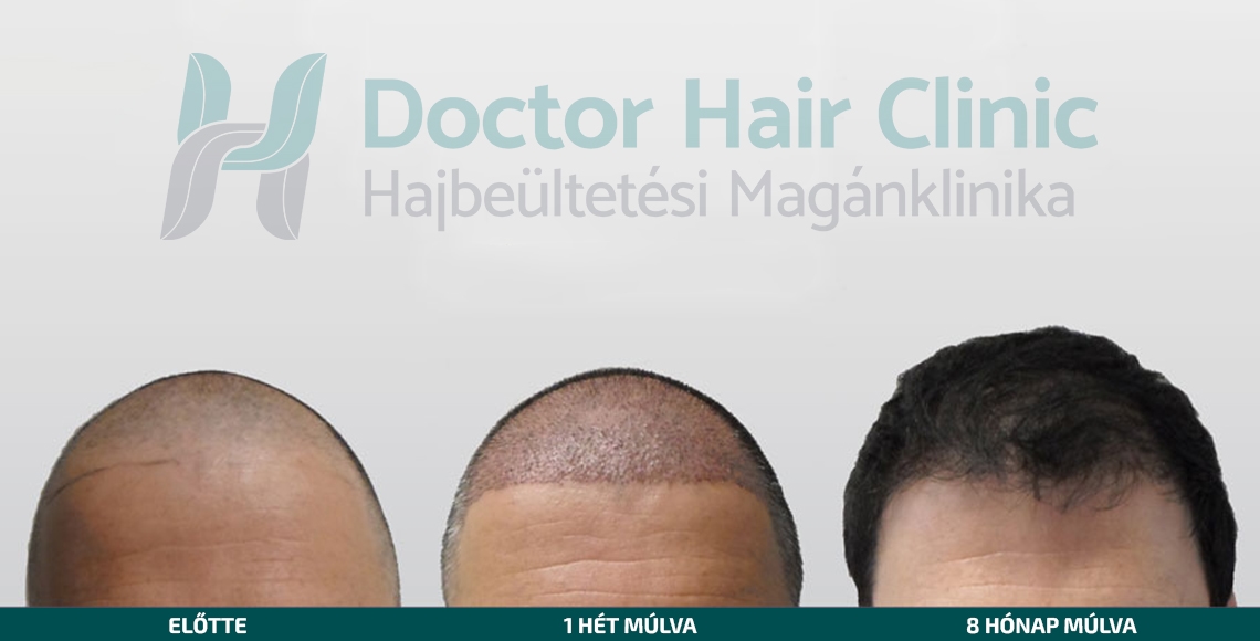 Doctor Hair Clinic Hajbeültetés referencia #7