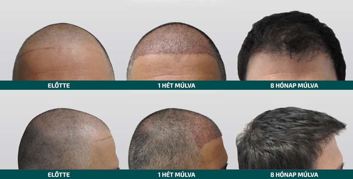Doctor Hair Clinic Hajbeültetés referencia #8