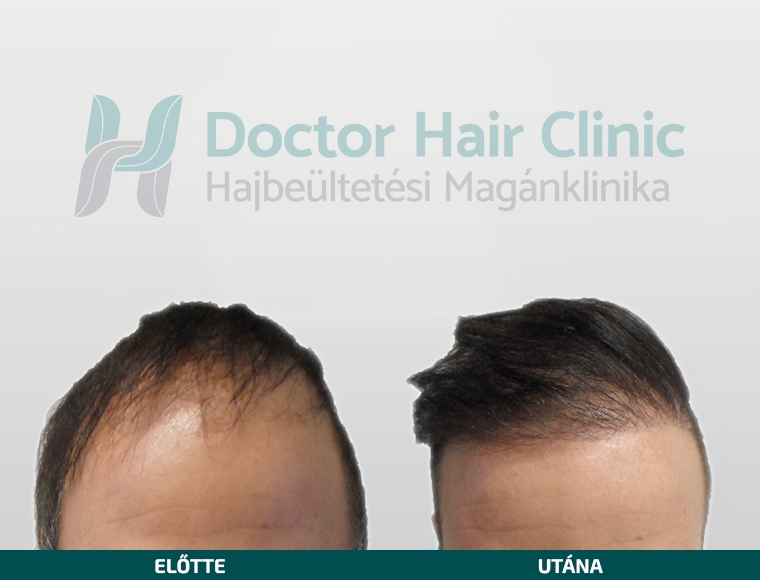 Doctor Hair Clinic Hajbeültetés referencia #9