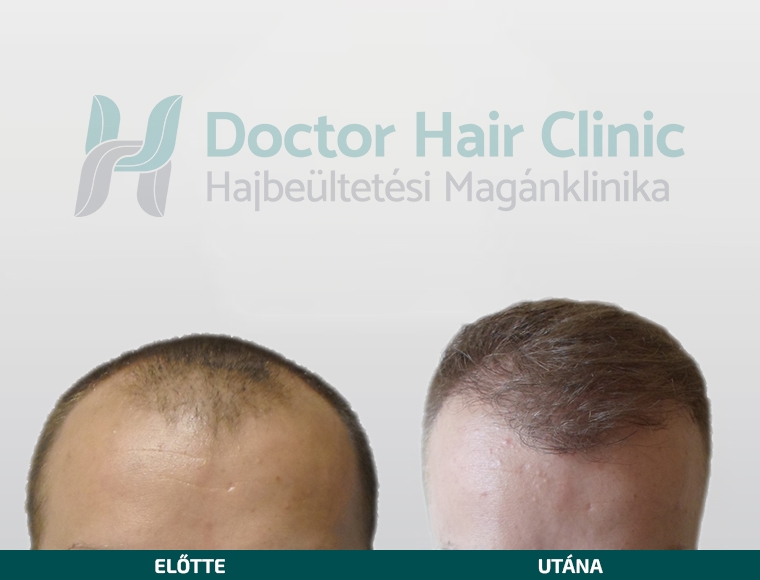 Doctor Hair Clinic Hajbeültetés referencia #10