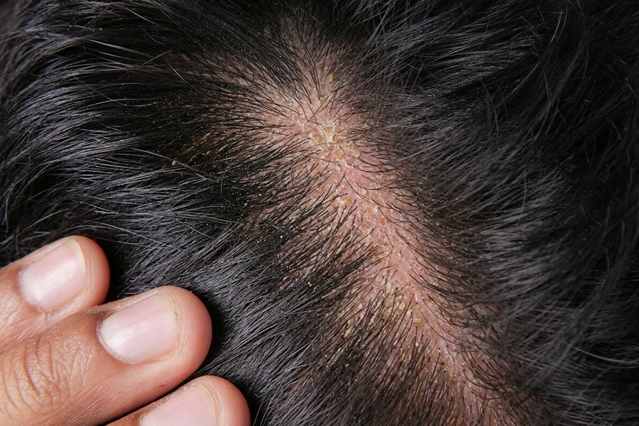 Doctor Hair Clinic Szeborreás fejbőr kezelése