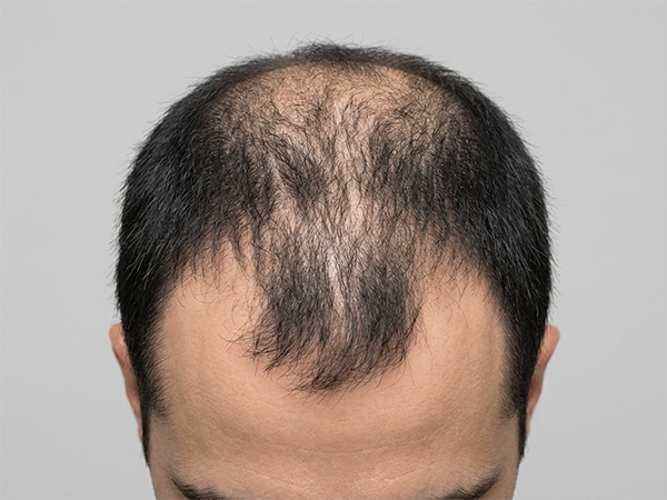 Androgenetikus alopecia (férfias és női típusú hajhullás)